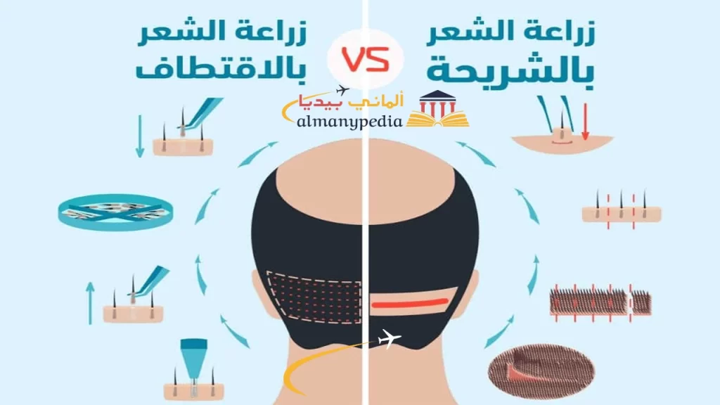 زراعة-الشعر-في-شتوتغارت