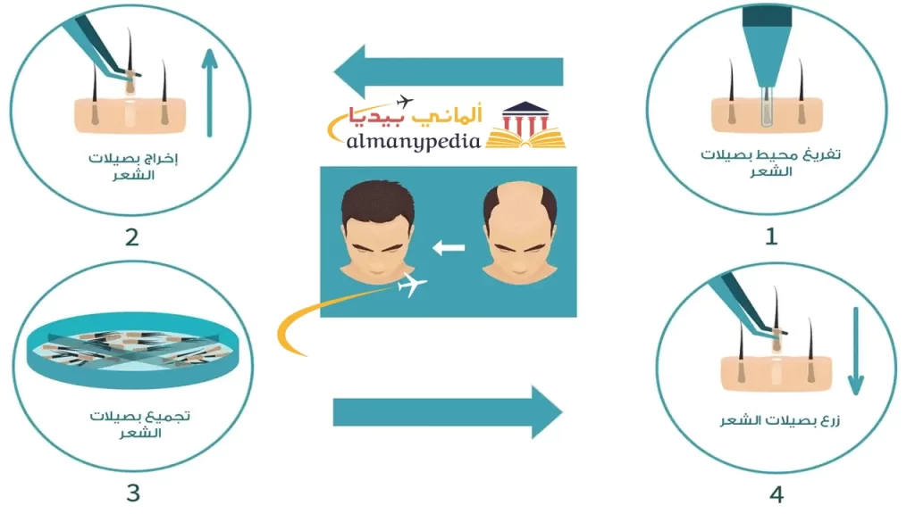 زراعة-شعر-في-المانيا