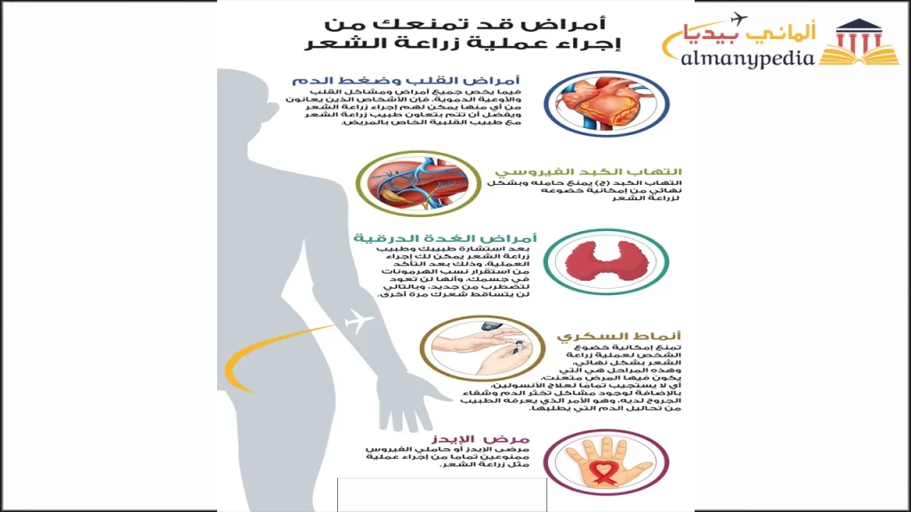 سعر-زراعة-الشعر-في-المانيا