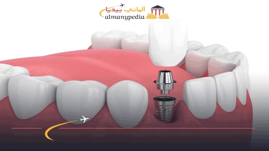 أنواع-زرعات-الأسنان-الألمانية