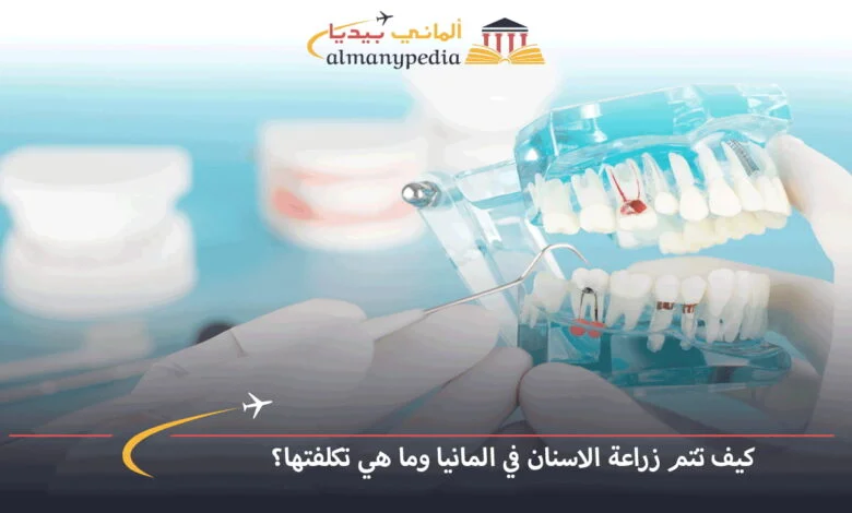 زراعة-الأسنان-في-برلين